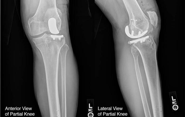 Partial Knee Replacement Rehab Protocol & Recovery Time