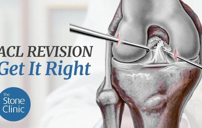 Best Treatment for ACL Revision 