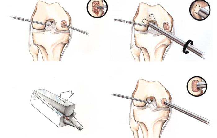 Articular Cartilage Paste Graft Surgical Technique Diagram