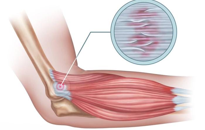 Tendonitis Treatment