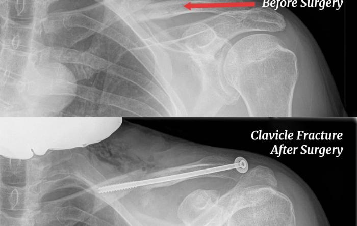 Clavicle Fracture