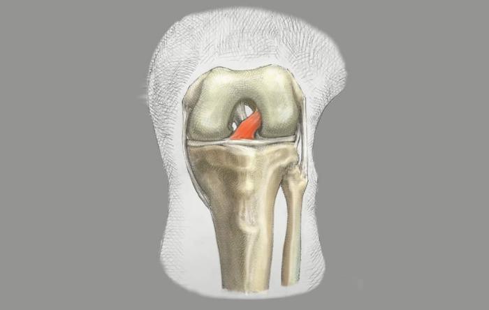 Do You Need an ACL?