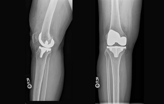 Total Knee Replacement Components Robotically Placed
