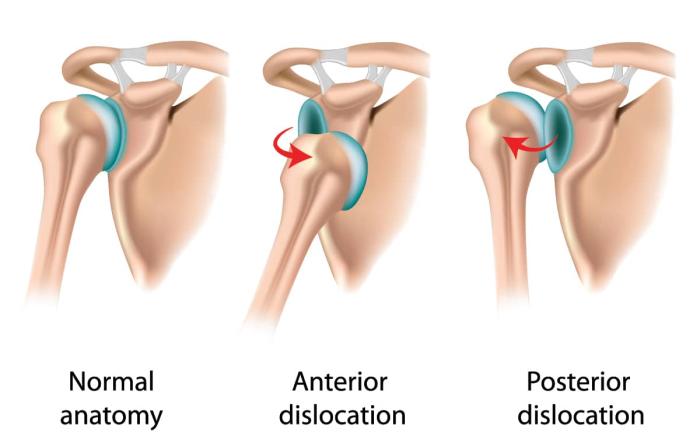 Shoulder Dislocation Treatment