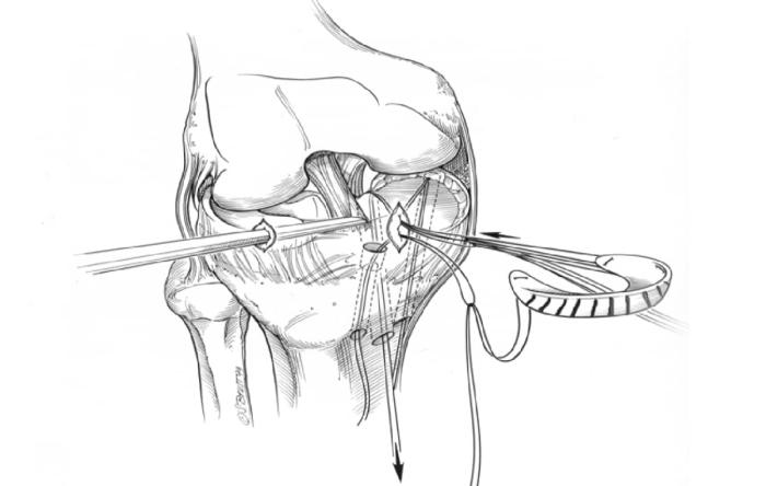 Meniscus Transplant Illustration