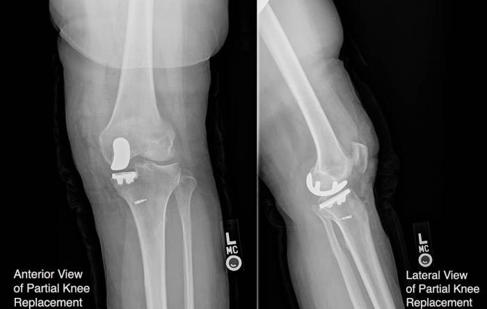 Robotically Placed Partial Knee Replacement