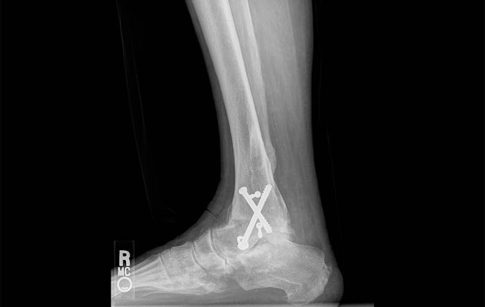 Ankle Fusion A Failure of Orthopaedic Science
