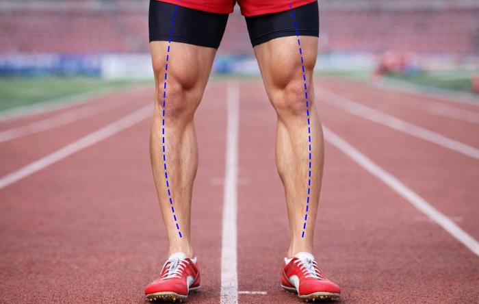 Bowlegged Runner | Joint Alignment & Running Mechanics