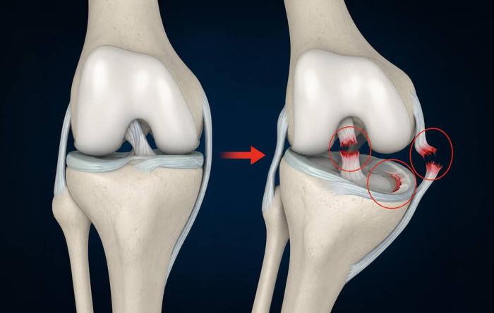 Knee-Injury-Digital-Illustration-(ACL-Meniscus) 