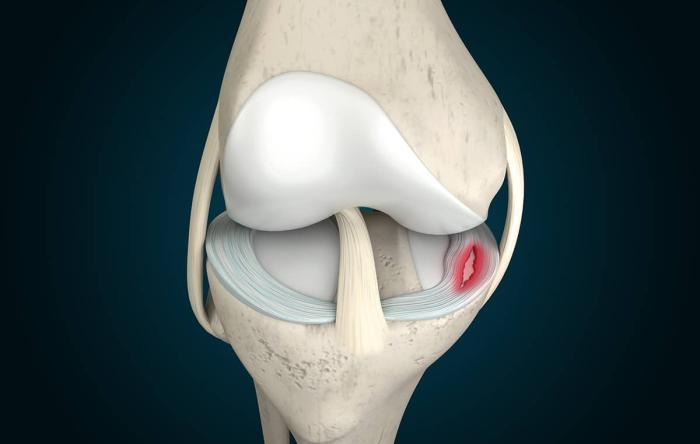 New Meniscus Tear Treatments