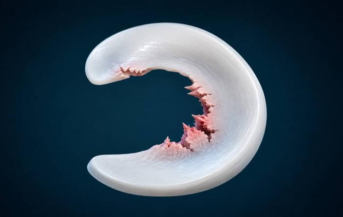 Degenerative Meniscus Tear Image