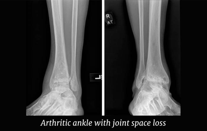 Ankle Arthritis Treatment: Know Your Surgeon’s Bias