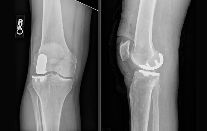 Lateral Partial Knee Replacement for Bone on Bone Arthritis