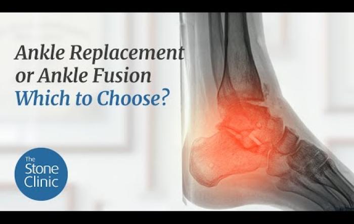Embedded thumbnail for Ankle Replacement or Ankle Fusion. Which to Choose?