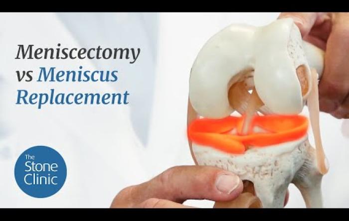 Embedded thumbnail for Meniscectomy vs Meniscus Replacement - Meniscus Tear Treatment Options