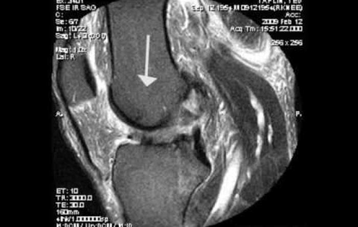 Embedded thumbnail for Anterior Cruciate Ligament Injury Overview