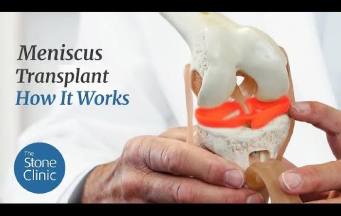 Embedded thumbnail for Meniscus Transplant: How it works